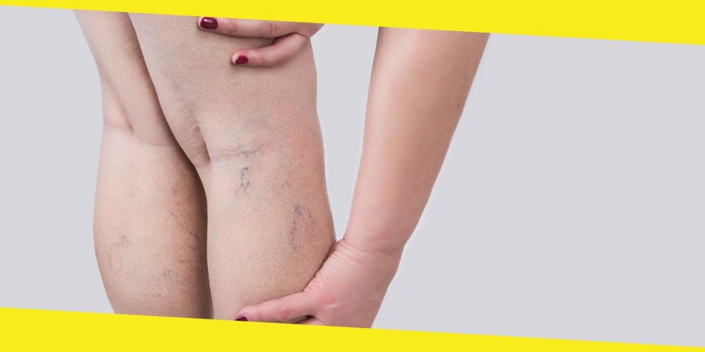 Here are 5 Effective Ways to Handle Varicose Veins