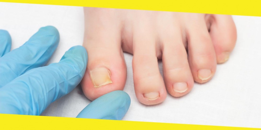 All You Need To Know About An Ingrown Toenail