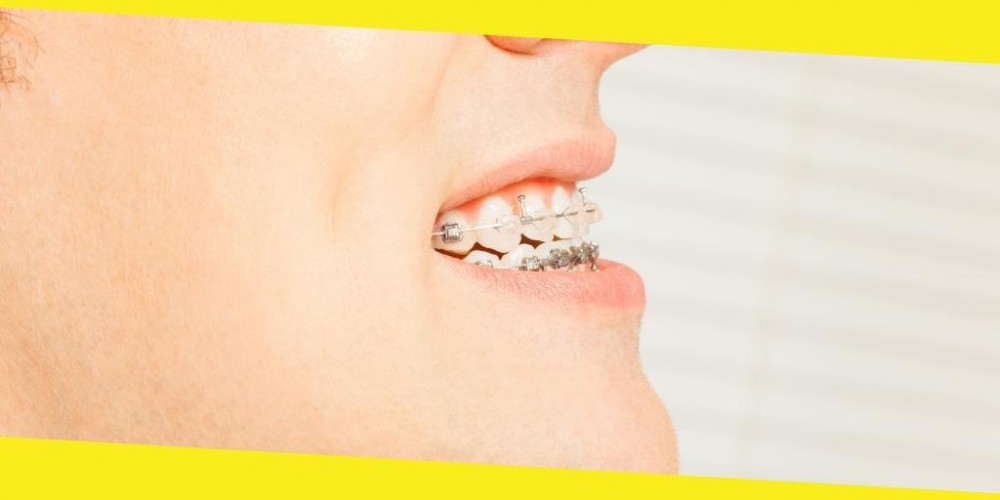 Types of Orthodontic Treatments You Need to Know About