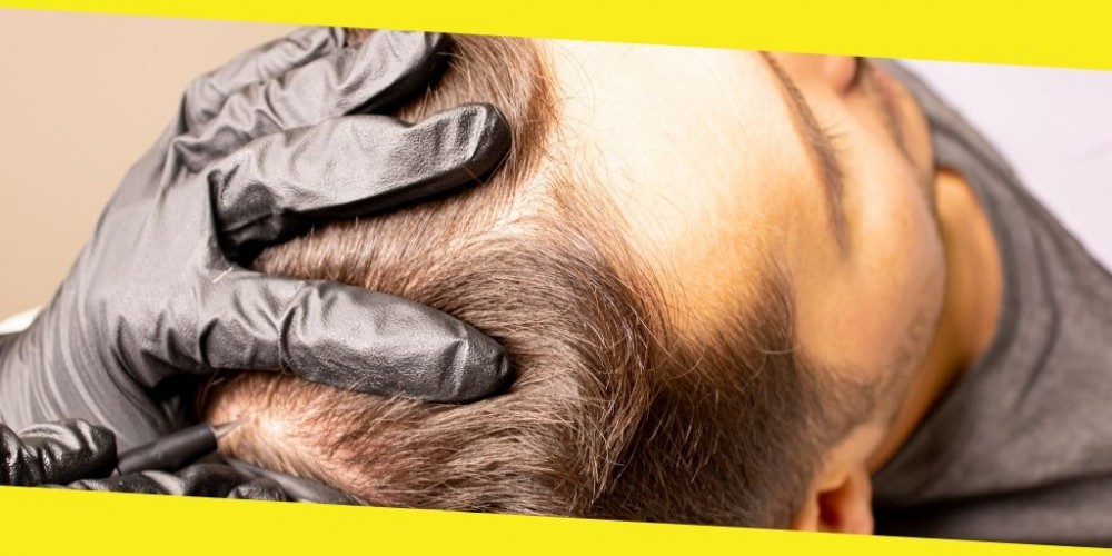 How Scalp Micropigmentation Can Improve Your Look