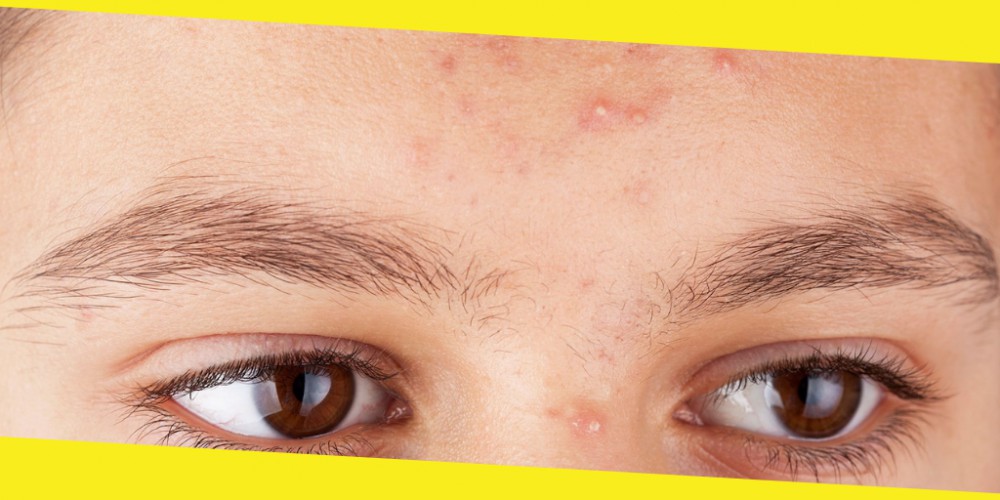 How to Get Rid of Acne for Good