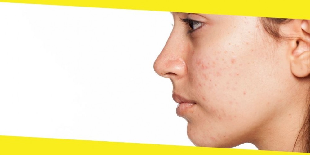 5 Unexpected Ways to Treat Your Acne